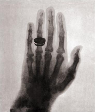 first human x-ray 1896