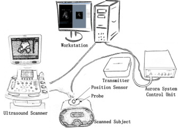 FREEHAND THREE DIMENSIONAL ULTRASOUND (US) IMAGING SYSTEM IN THE ASSESSMENT OF SCOLIOSIS