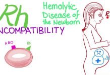 Rhesus incompatibility and recurrent miscarriages: The role of sonographers in public sensitization
